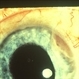 Ciliary Body Tumor Ciliary Body Tumor